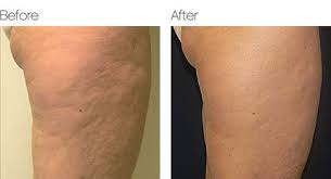 radiofrequency-for-cellulite-fat-before
